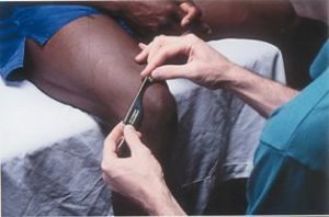 Graston Technique for knee pain or Runner's knee