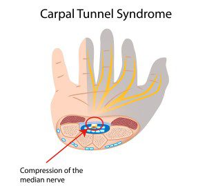 carpal tunnel syndrome diagram of the median nerve