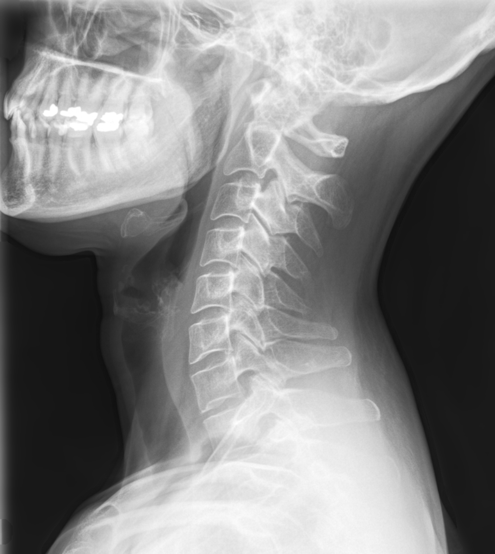 The Value of X-ray in Chiropractic Treatment - Brookfield Chiropractor