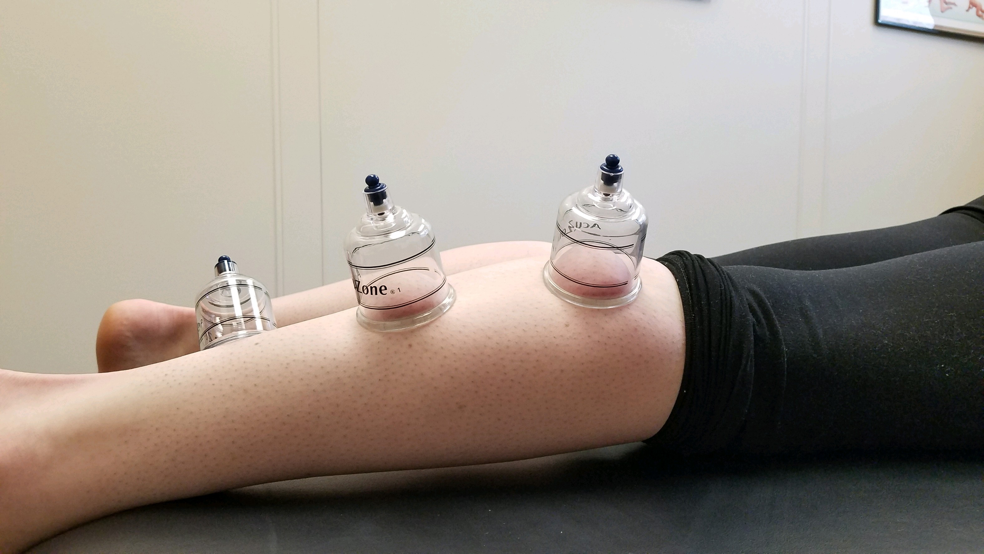 myofascial cupping therapy brookfield