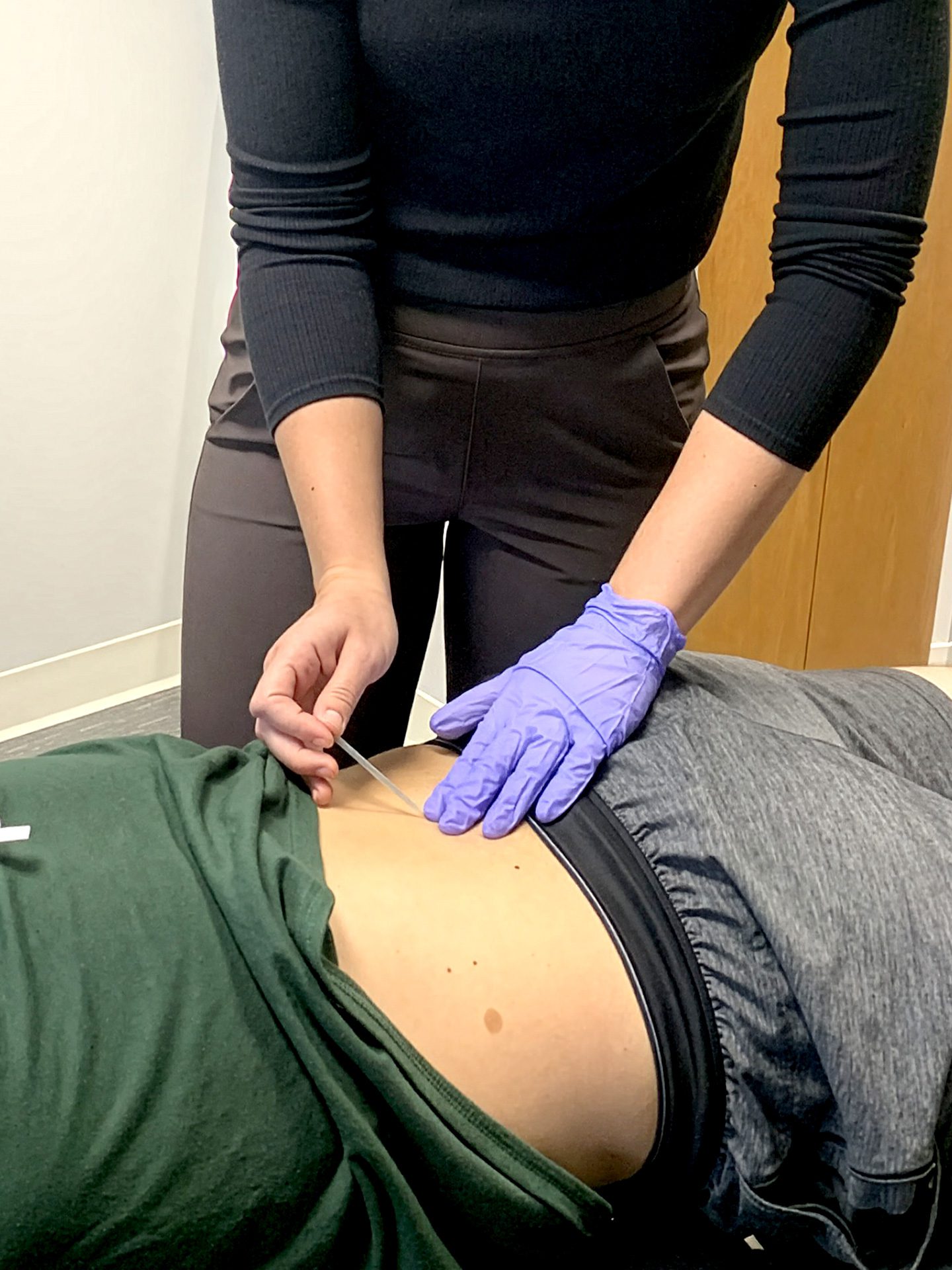 Dry Needling being performed on patients lower back